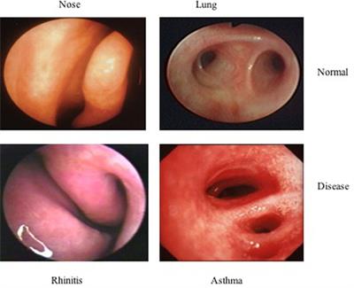 The Nose and the Lung: United Airway Disease?